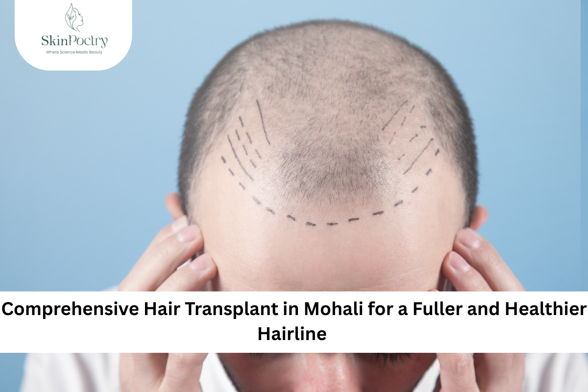 hair transplant in Mohali